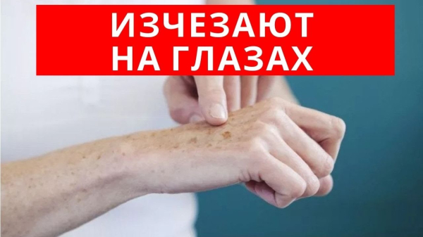 Особенности лечения папиллом в домашних условиях хозяйственным мылом