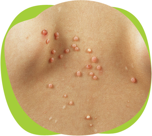 Папиллома у ребенка на руке: что делать и как лечить