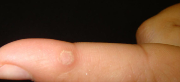 Папилломы на руках: причины, симптомы и лечение