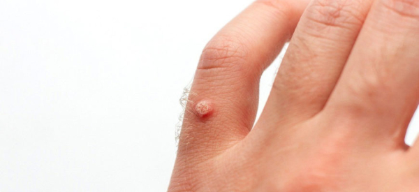 Можно ли прижечь папиллому зеленкой?