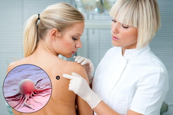 Папилломы на спине: причины и лечение
