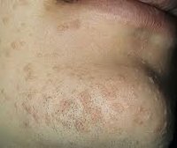 Плоские папилломы: симптомы, причины, лечение и профилактика