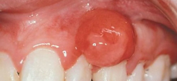 Папиллома на внутренней стороне щеки: симптомы и лечение