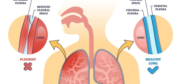 Плеврит легких: виды, причины, диагностика и лечение