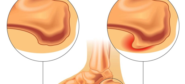 Плантарный фасциит стопы: причины, симптомы, лечение