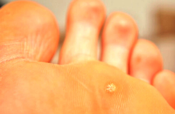 Бородавка на ножке: причины и лечение