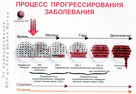 Вирус папилломы человека 66 типа: причины и лечение