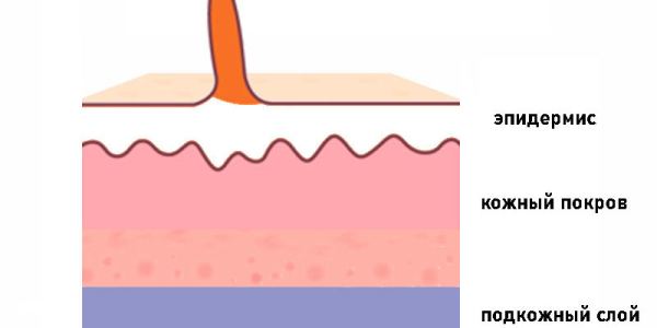 Нитевидные папилломы: причины, симптомы и лечение