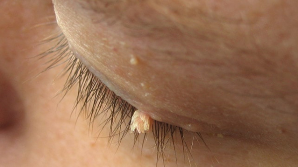 Как вылечить папилломы во рту народными средствами?