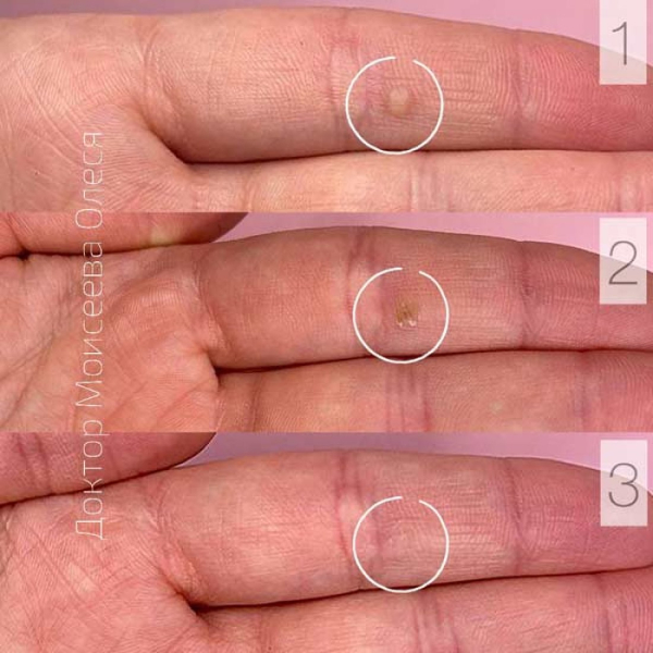 Как избавиться от бородавок на ладони у ребенка