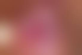 Папиллома в заднем проходе у женщин: причины и лечение