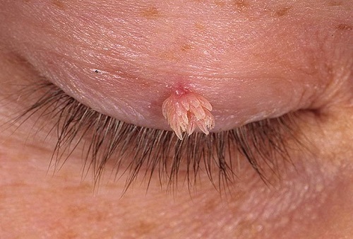 Как избавиться от бородавки на глазу