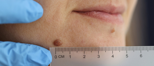 Как убрать папиллому под глазом: лучшие способы