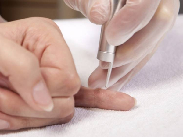 Как вытащить бородавку с корнем: лучшие способы