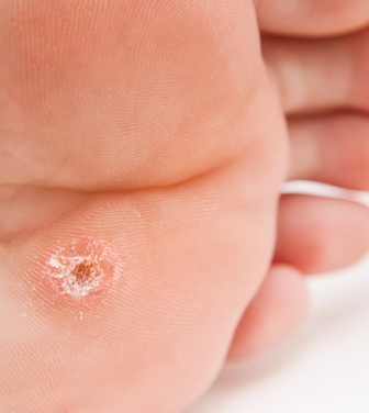 Последствия удаления бородавки на руке