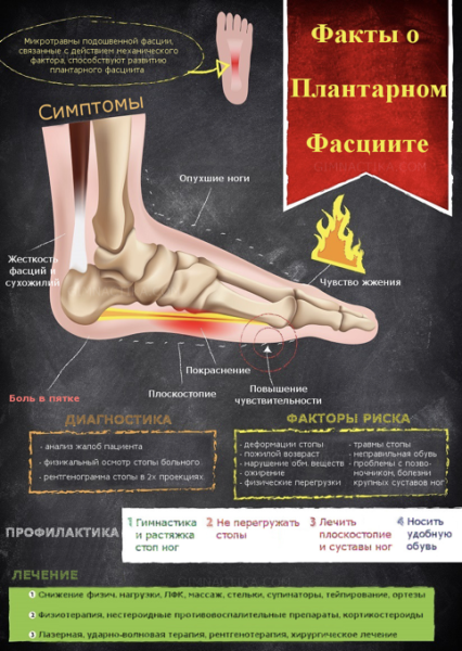 Плантарный фасциит стопы: причины, симптомы, лечение