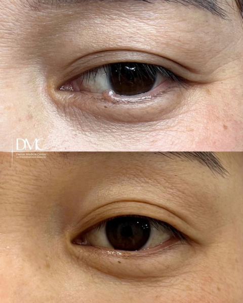 Как убрать папиллому под глазом: лучшие способы