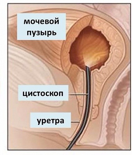 Папиллома в уретре: причины, симптомы, лечение
