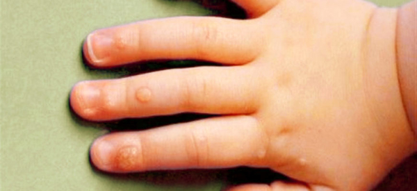 Бородавки у ребенка на руках: причины, симптомы и лечение