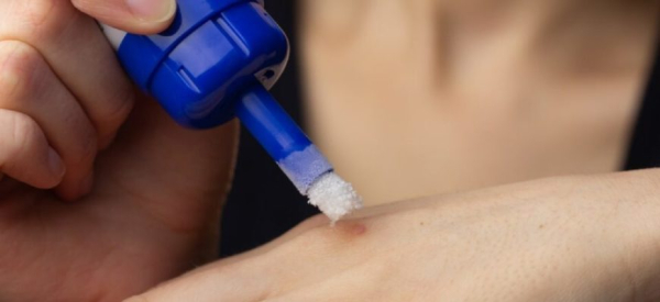 Какой врач лечит бородавки на руках?