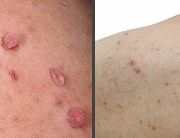 Как отличить бородавку от прыща?