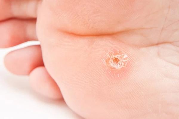 Особенности лечения подошвенных папиллом