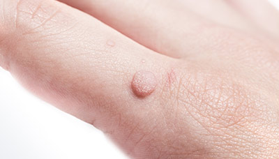 Папилломы у детей: причины, симптомы и лечение