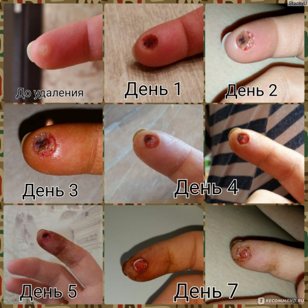 После удаления болит место удаления бородавки: что делать?
