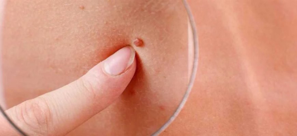 Симптомы и лечение папилломы на миндалине