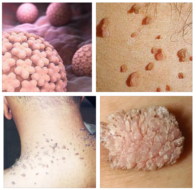 Воспалилась папиллома, что делать?