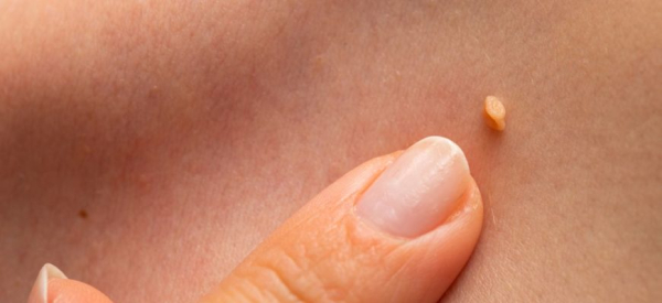 Что делать, если лопнула папиллома?