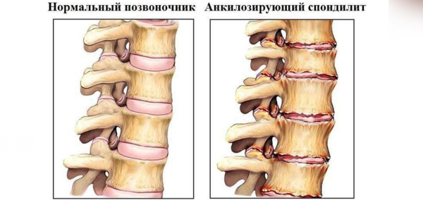Спондилит: причины, симптомы и лечение воспаления позвоночника