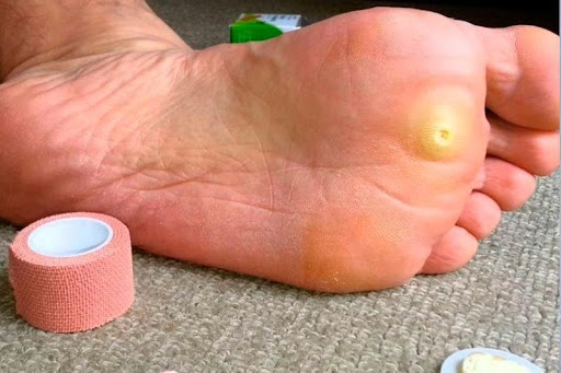 Бородавка на ноге при беременности