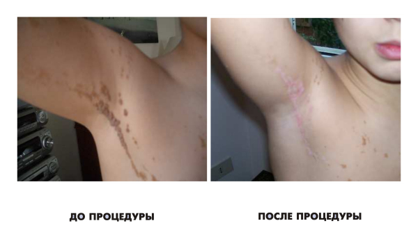 Лазерное удаление папиллом