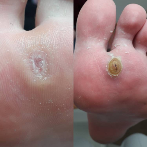 Не заживает рана после удаления бородавки