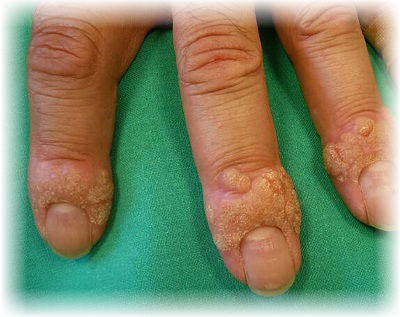 Какие бывают бородавки на руках и на пальцах рук