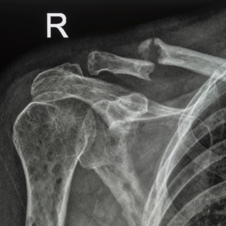 Синостоз: причины, виды, симптомы, лечение