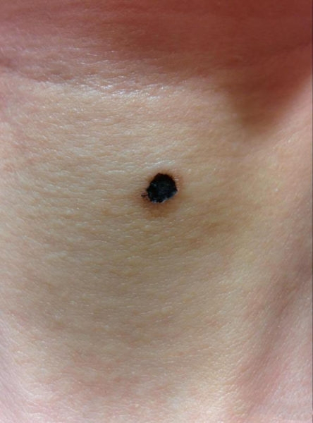 Папиллома может отвалиться сама: миф или реальность?