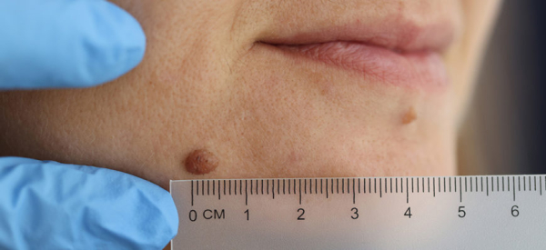 Как избавиться от папиллом под грудью?