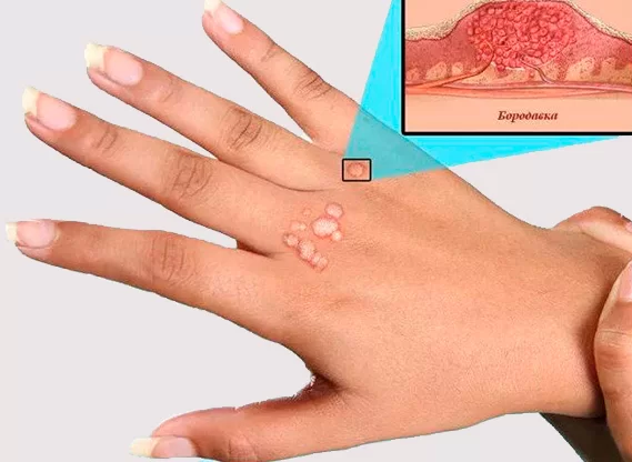 Какой врач лечит бородавки на руках?