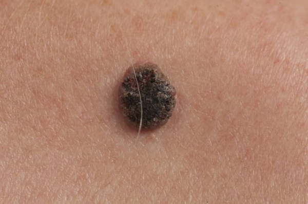 Может ли папиллома перерасти в рак?