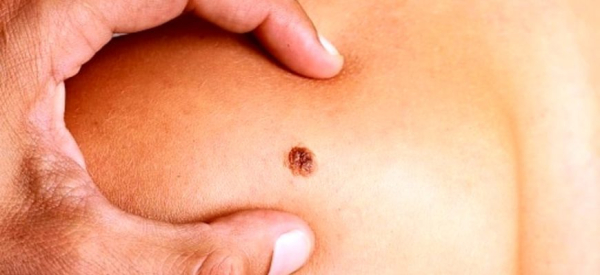 Как развести марганцовку и выжечь бородавку