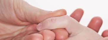 Папилломы на руках: причины, симптомы и лечение