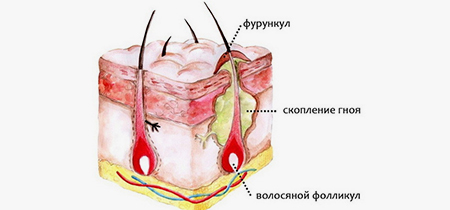 Гнойный фурункул: особенности недуга и лечение