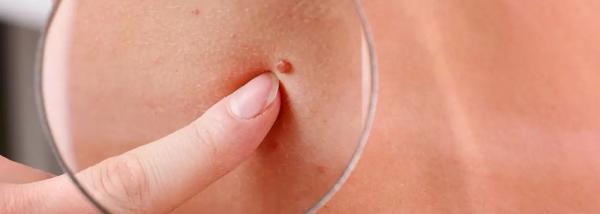 От чего растут папилломы: основные причины