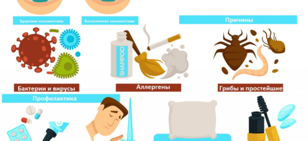 Кератоконъюнктивит: причины, симптомы, лечение, профилактика