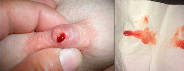 Внутрипротоковая папиллома молочной железы: симптомы и лечение