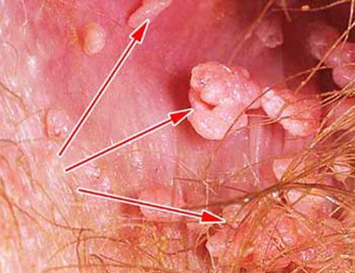 Бородавки на интимных местах у женщин: симптомы и лечение