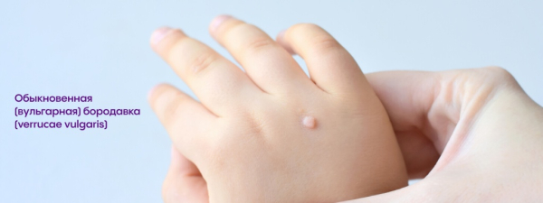 Причины, симптомы, диагностика и лечение бородавок у детей