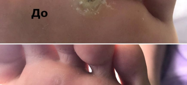 Отпала бородавка, что делать